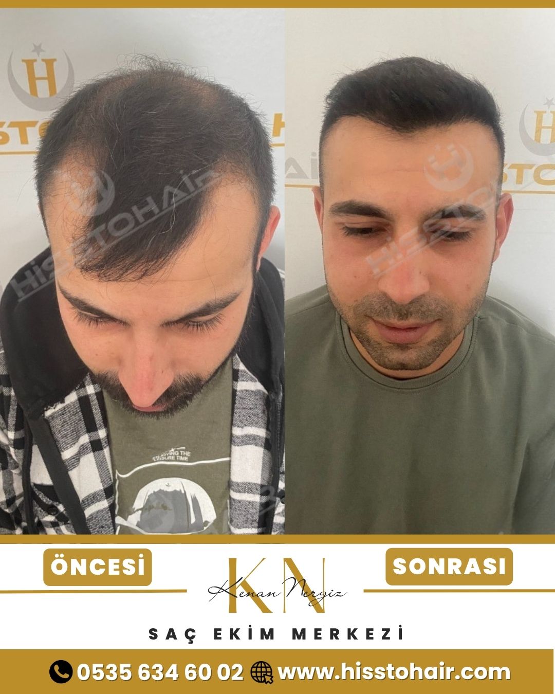 İzmir Torbalı Saç Ekim Sonuçları