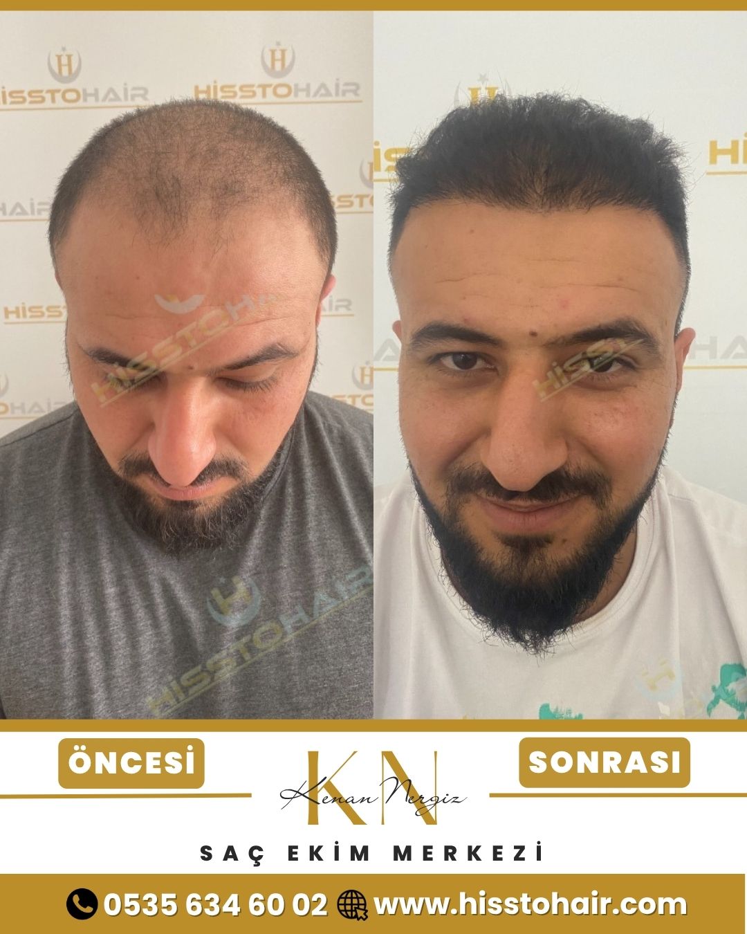 İzmir Torbalı Saç Ekim Sonuçları