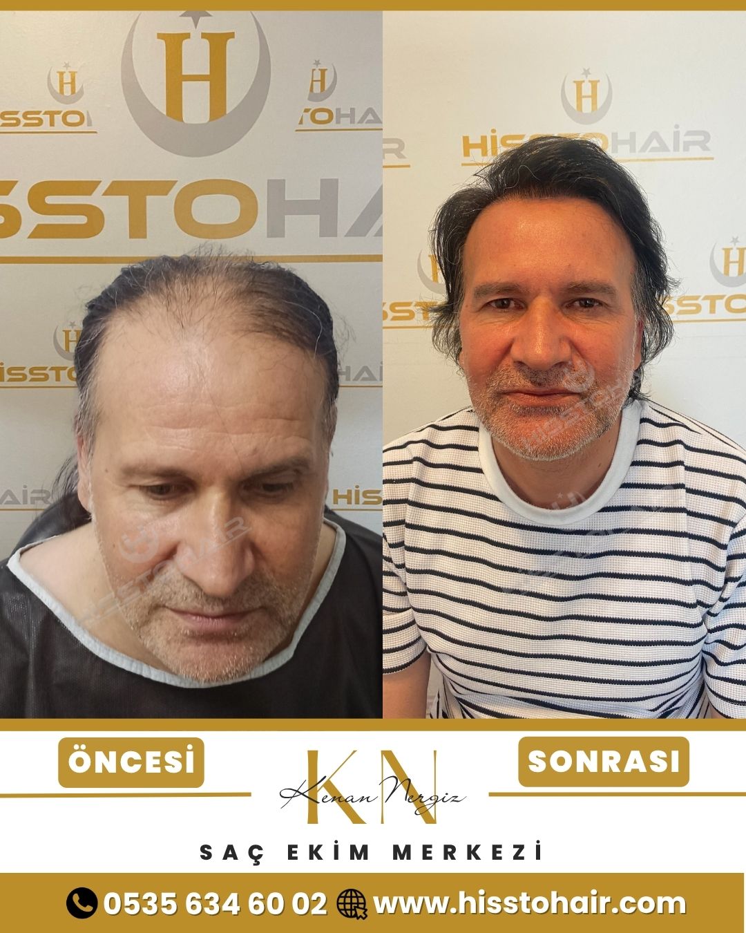 İzmir Torbalı Saç Ekim Sonuçları