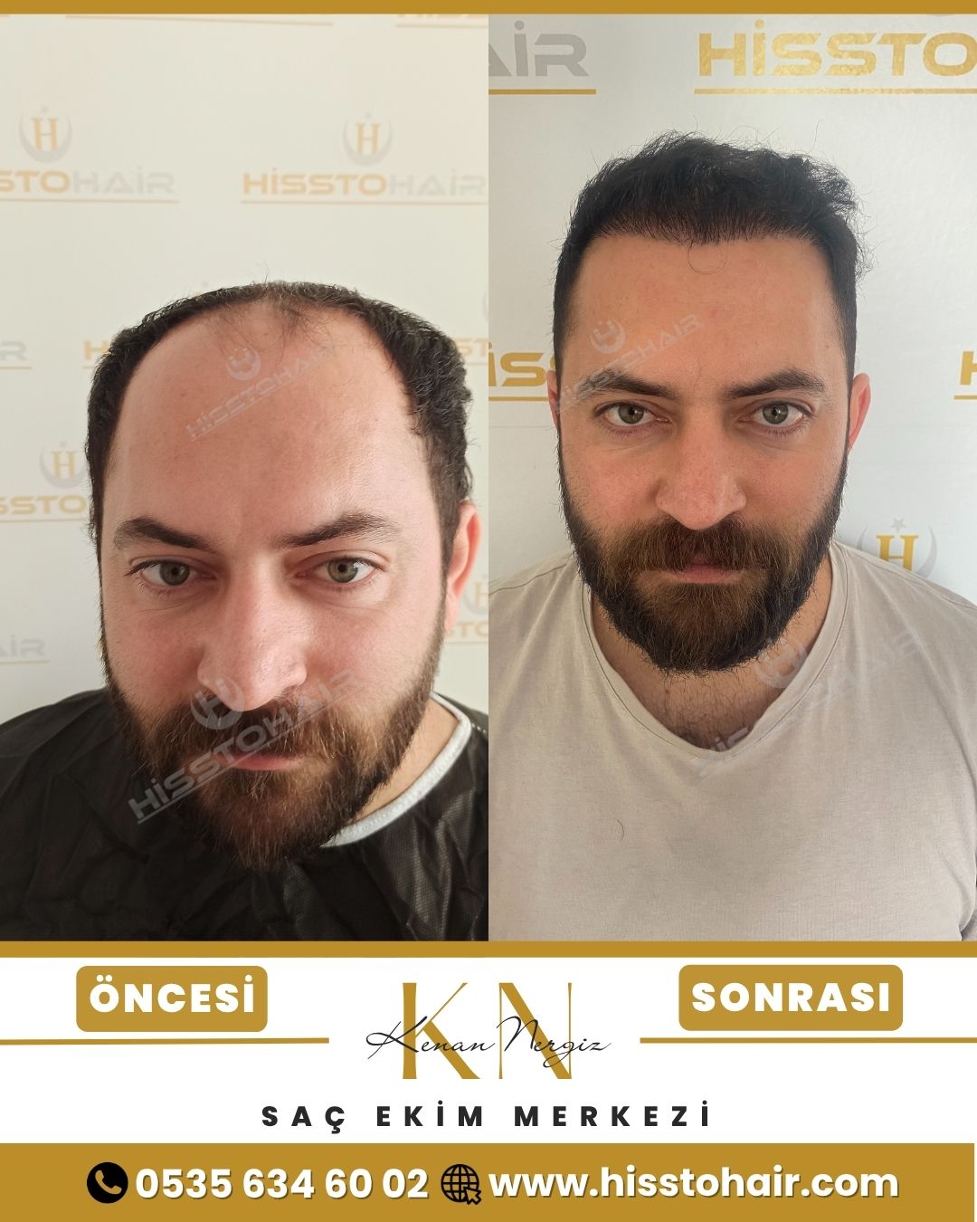Honaz Saç Ekim Sonuçları - Saç Ekim Kliniği