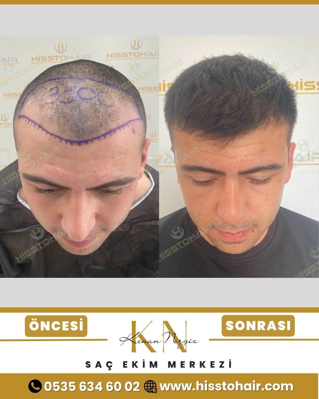 Honaz Saç Ekim Sonuçları - Saç Ekim Kliniği
