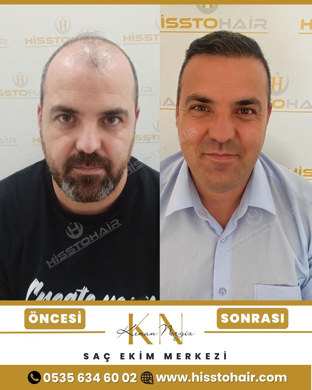 Honaz Saç Ekim Sonuçları - Saç Ekim Kliniği