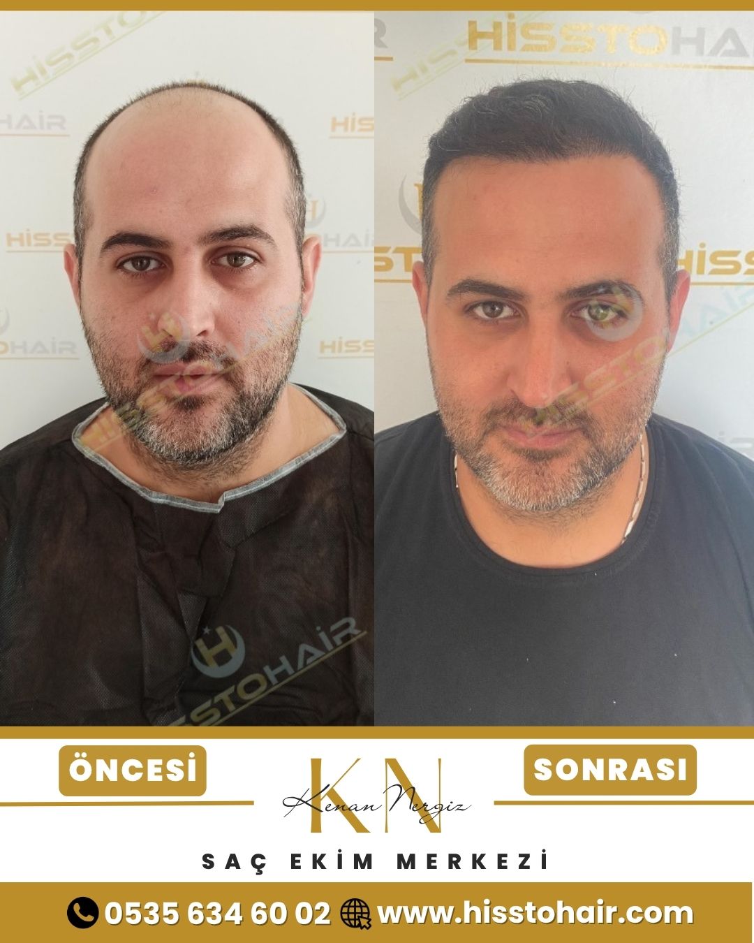 İzmir Torbalı Saç Ekim Sonuçları